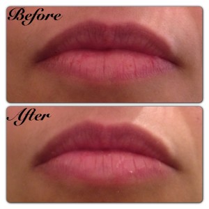 Lips Before and After